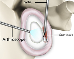 Picture of Capsular Release
