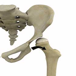 Picture of Developmental Dysplasia