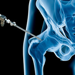 Picture of Hip Arthroscopy