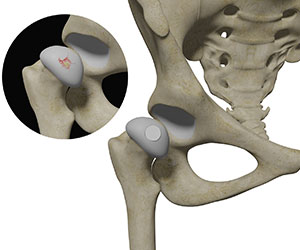 Picture of Hip Cartilage Restoration