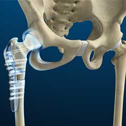 Picture of Hip Fracture Surgery