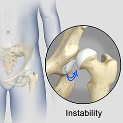 Picture of Hip Instability
