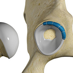 Picture of Hip Labral Reconstruction