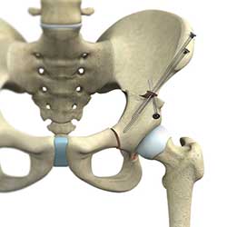 Picture of Hip Preservation Surgery