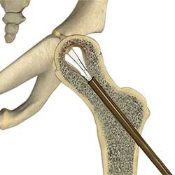 Picture of Hip Reconstruction