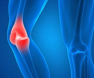 Picture of Knee Injuries