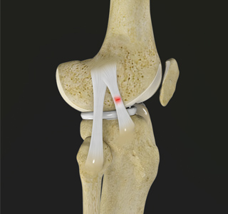 Picture of Knee Sprain