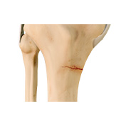 Picture of Knee Stress Fractures