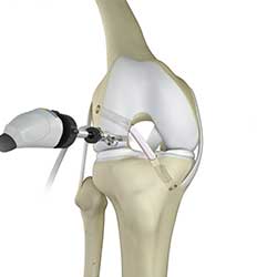 Picture of Knee Trauma Reconstruction