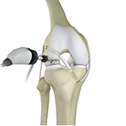 Picture of Knee Trauma