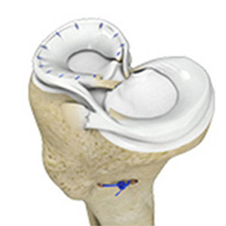 Picture of Meniscal Tears