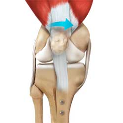 Picture of Patella Stabilization