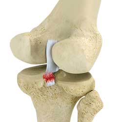 Picture of PCL Injuries