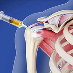 Picture of Platelet-Rich Plasma (PRP) Injection