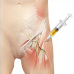 Picture of Platelet-Rich Plasma (PRP) Injections for the Hip