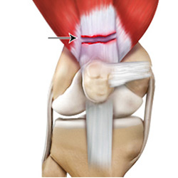 Picture of Quadriceps Tendon Rupture