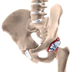 Picture of Revision Hip Surgery