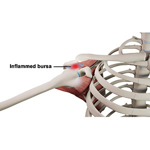 Picture of Shoulder Bursitis