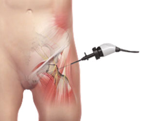 Picture of Snapping Hip Syndrome