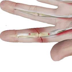 Picture of Tendon Injuries