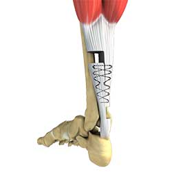 Picture of Tendon Repair Surgery