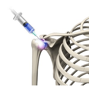 Picture of Viscosupplementation for Shoulder Arthritis
