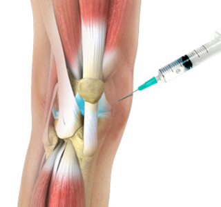Picture of Viscosupplementation