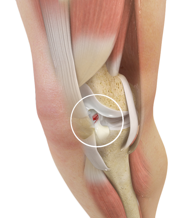 ACL Tears