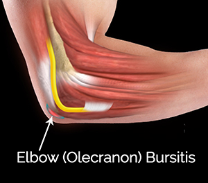 Bursitis