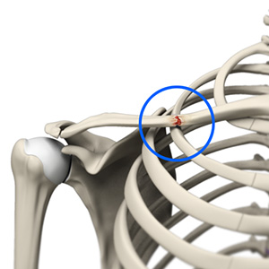 Clavicle Fracture