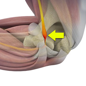Cubital Tunnel Syndrome (Ulnar Nerve Entrapment)
