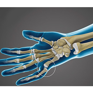 Finger Dislocation