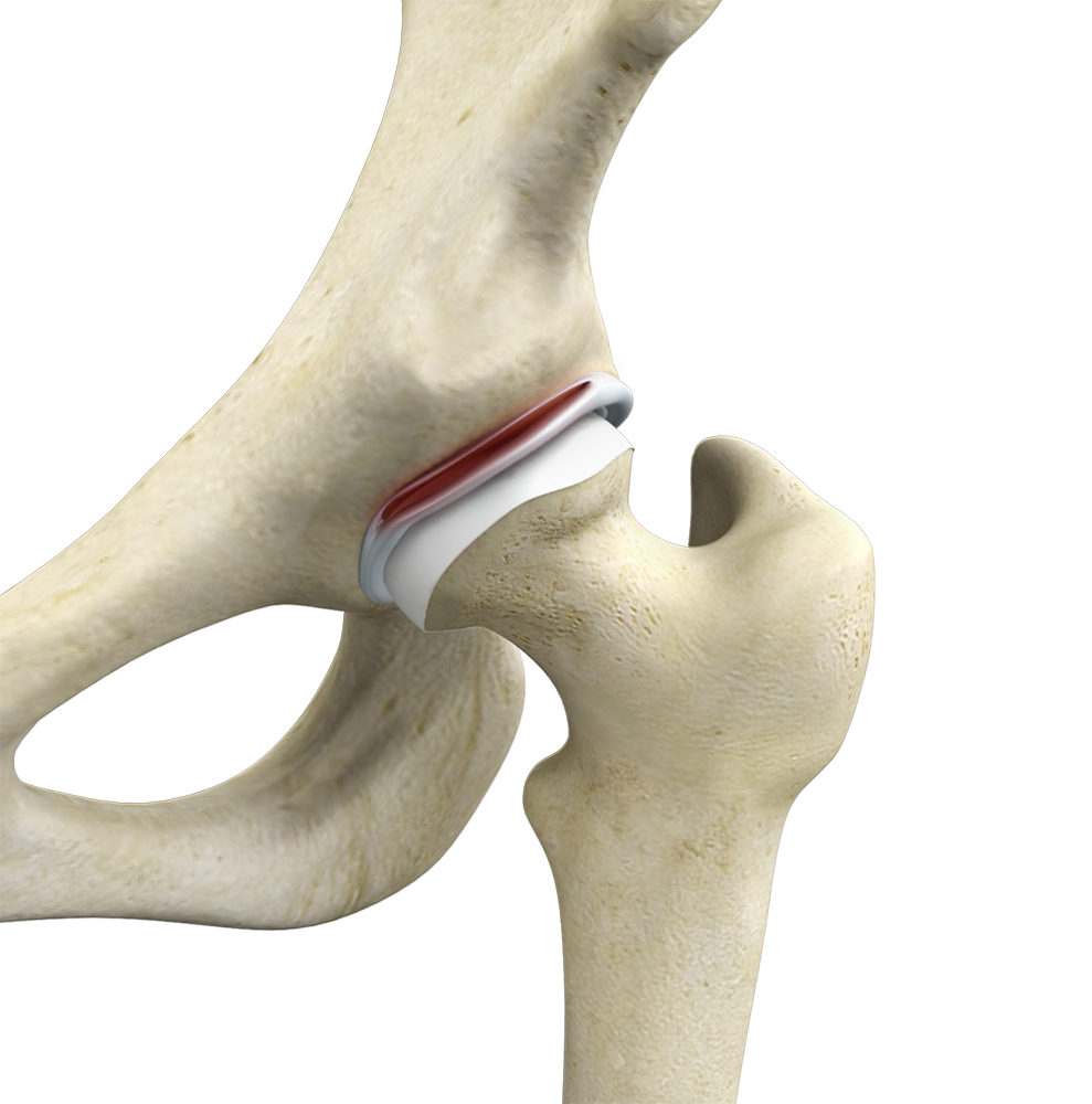 Hip Labral Tear