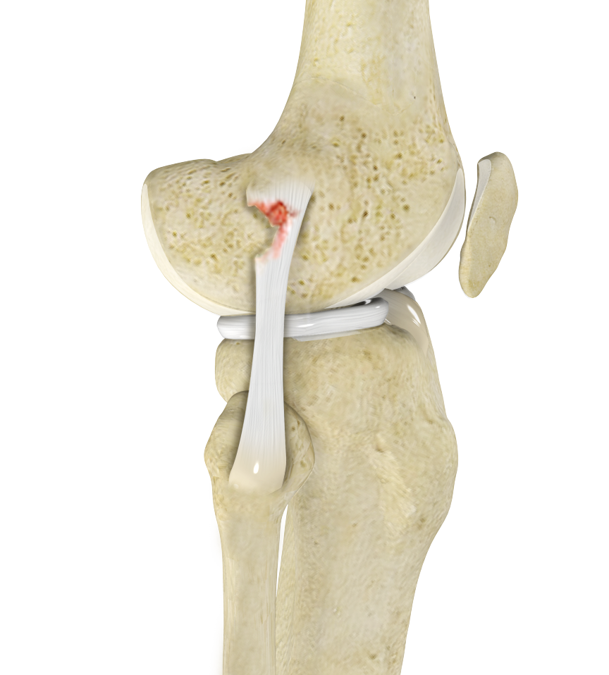 Lateral Collateral Ligament (LCL) Tear