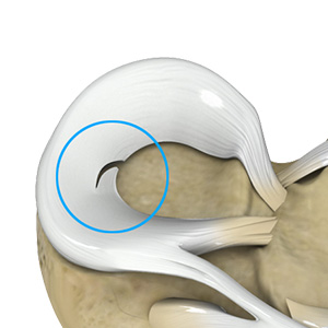 Meniscal Tears