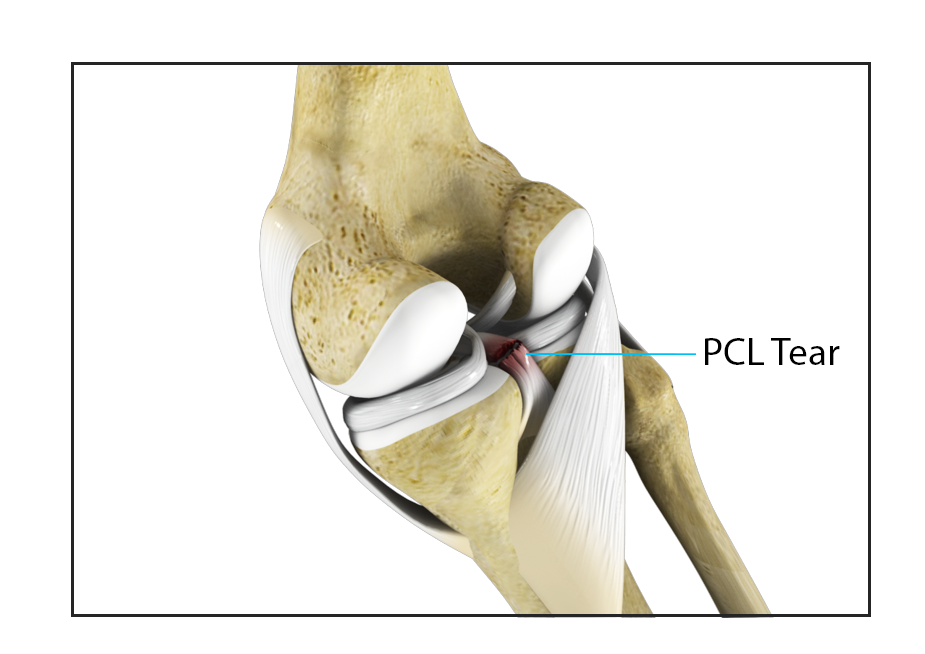 PCL Injuries