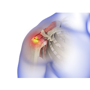 Rotator Cuff Tear