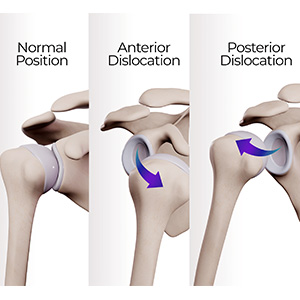 Shoulder Dislocation