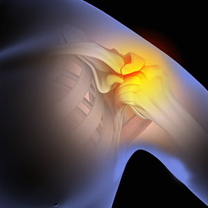 Shoulder Impingement