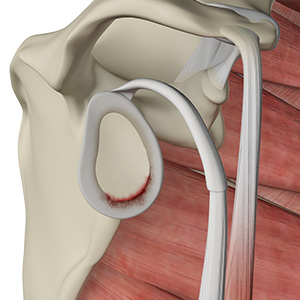 Shoulder Labral Tear