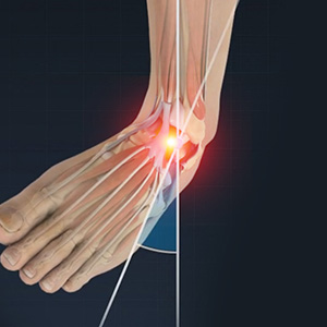 Sprains and Strains