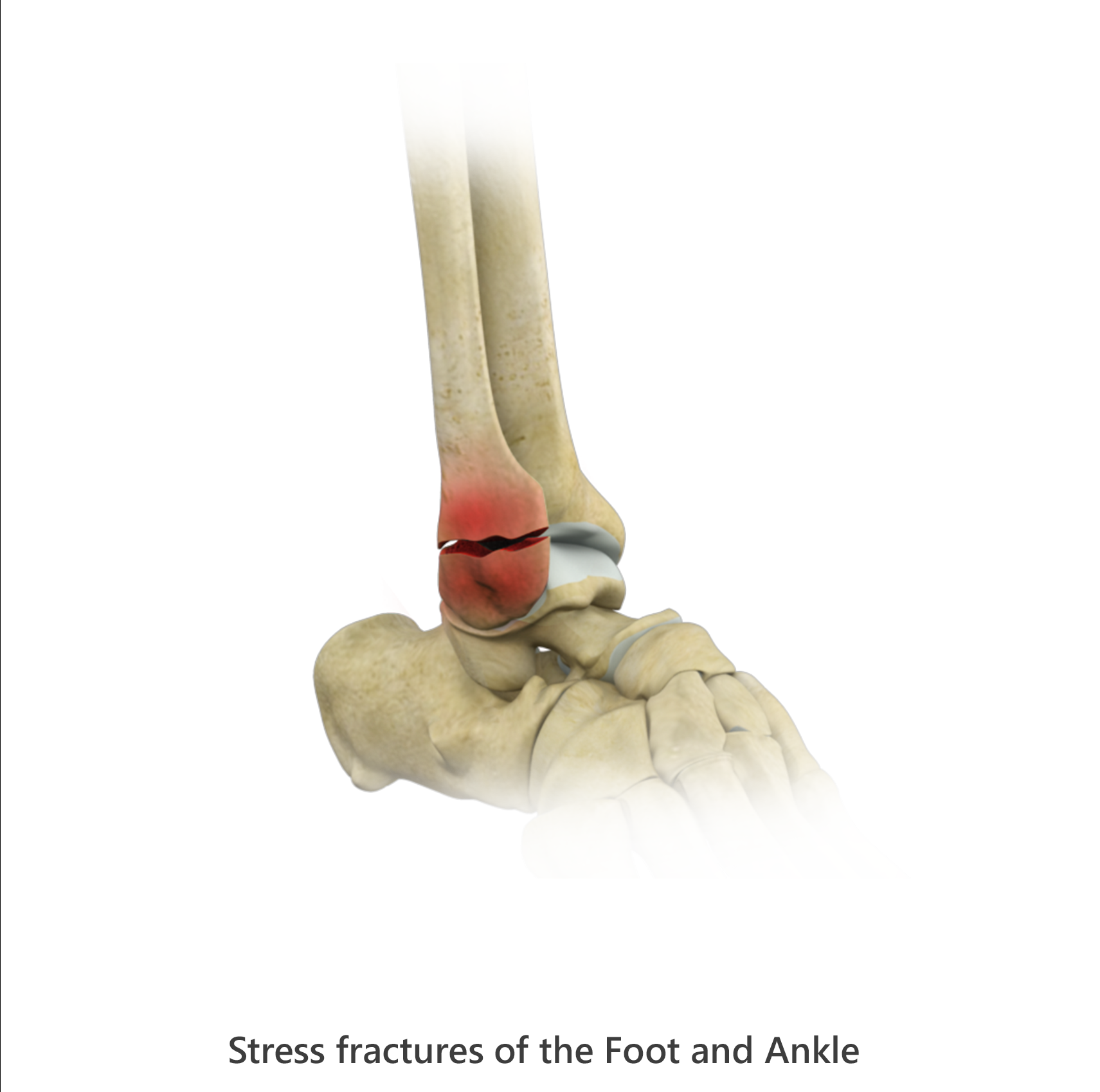 Stress Fractures of Foot and Ankle