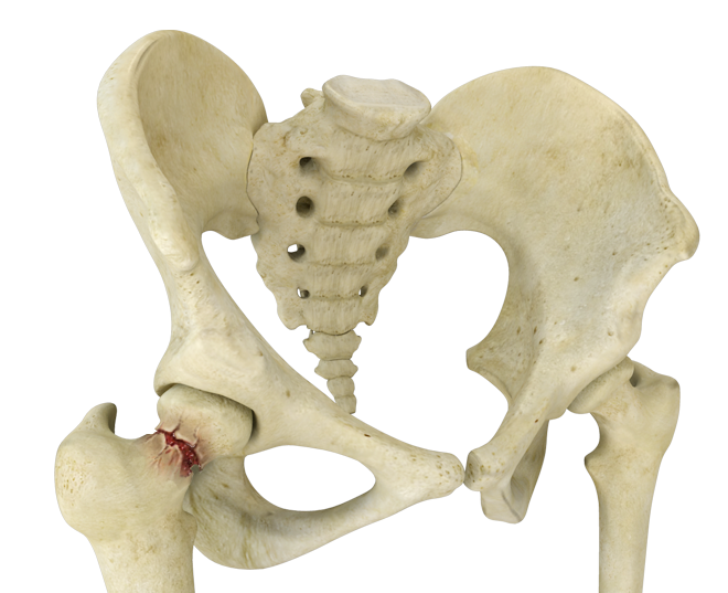 Stress Fractures of the Hip