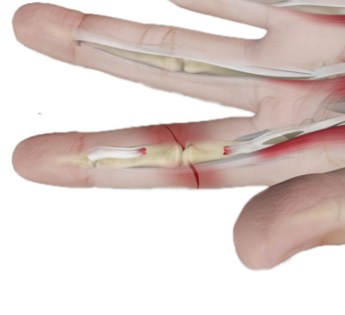 Tendon Injuries