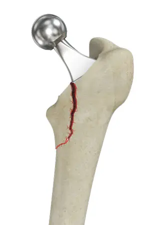 Femur Fracture pic