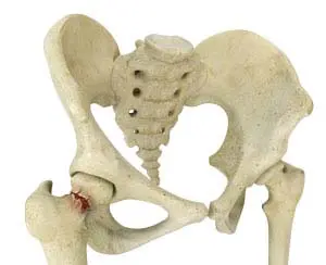Hip Fracture pic