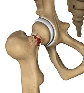 Hip Injury pic