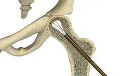 Hip Reconstruction pic