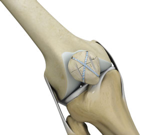 Knee Fracture Surgery pic