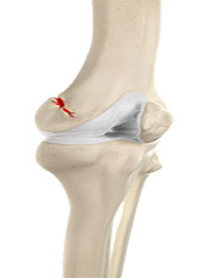 Knee Fracture pic